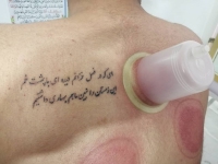 حجامت زالو درمانی برداشتن خال و زگیل تناسلی در مشهد