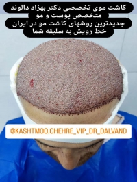 کلینیک تخصصی کاشت مو چهره vip در تهران