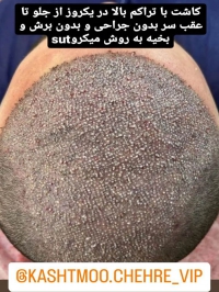کلینیک تخصصی کاشت مو چهره vip در تهران