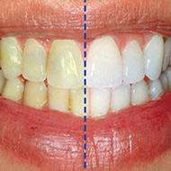 عوامل موثر در تغییر رنگ دندان ها